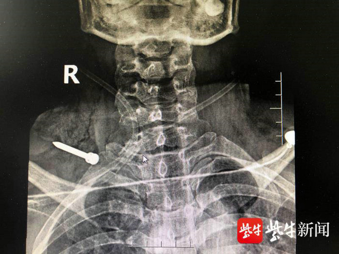 扬子晚报（紫牛新闻）：飞来横祸 苏州一女子被铁钉扎进脖子.jpg