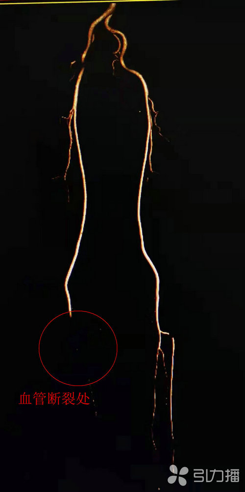 苏报集团（引力播）：中年男子右下肢面临截肢风险 医生用自体移植术重建血管通路.jpg