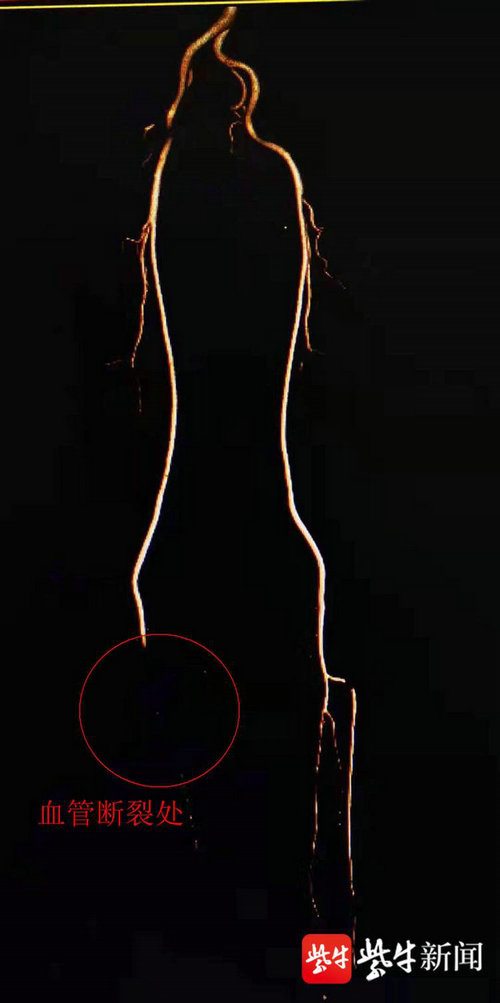 紫牛新闻：中年男子右下肢面临截肢风险 医生用自体移植术重建血管通路.jpg